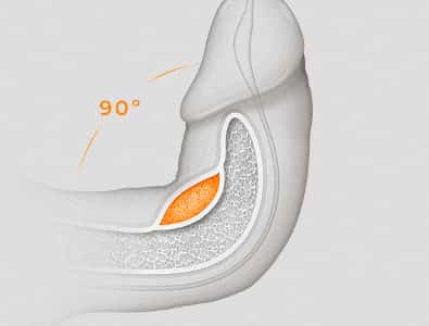 Corrección del pene curvado