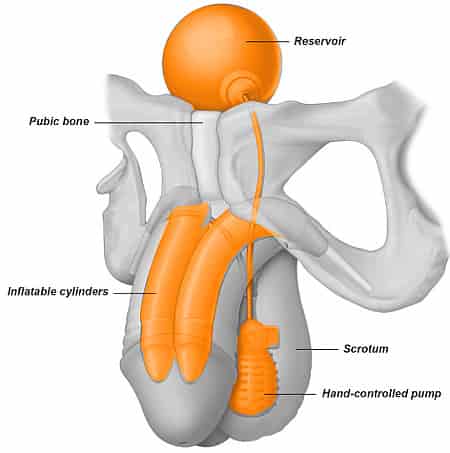 Penis derisi altına madde enjeksiyonu